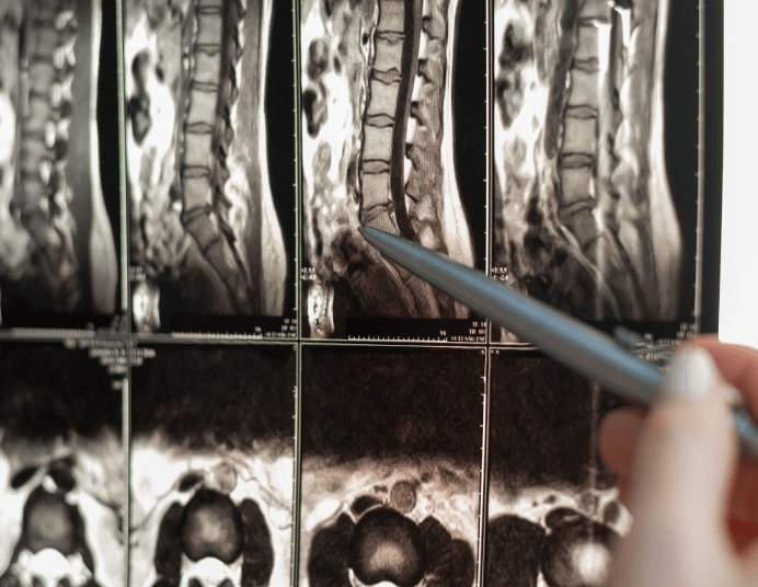 bpc 157 spinal stenosis BPC-157