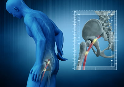 MicroTube Spine Surgery - Lumbar Radiculopathy